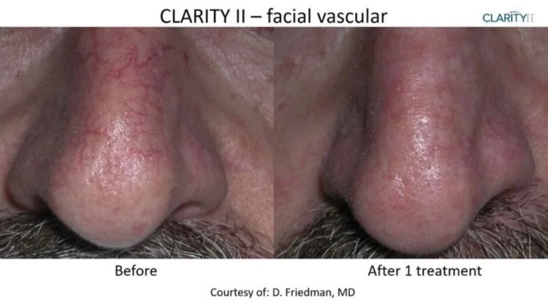 Clarity II facial vascular treatment: visible nose capillaries before, and clearer skin after one treatment
