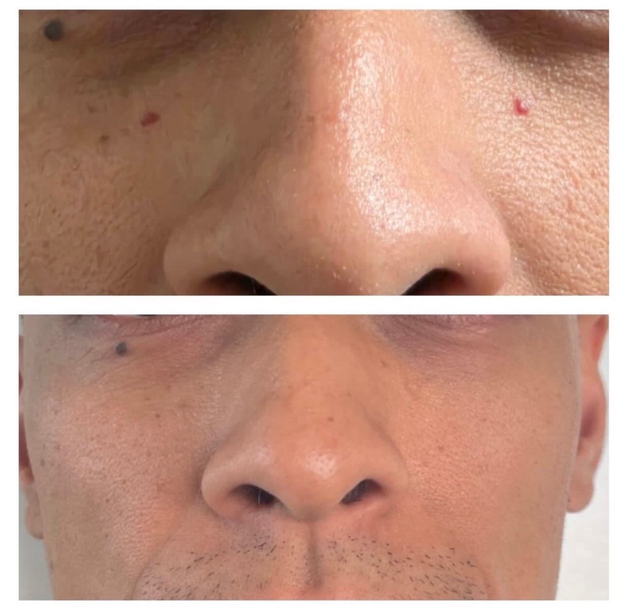 Facial vascular lesions on the cheeks and nose before laser treatment, and cleared after