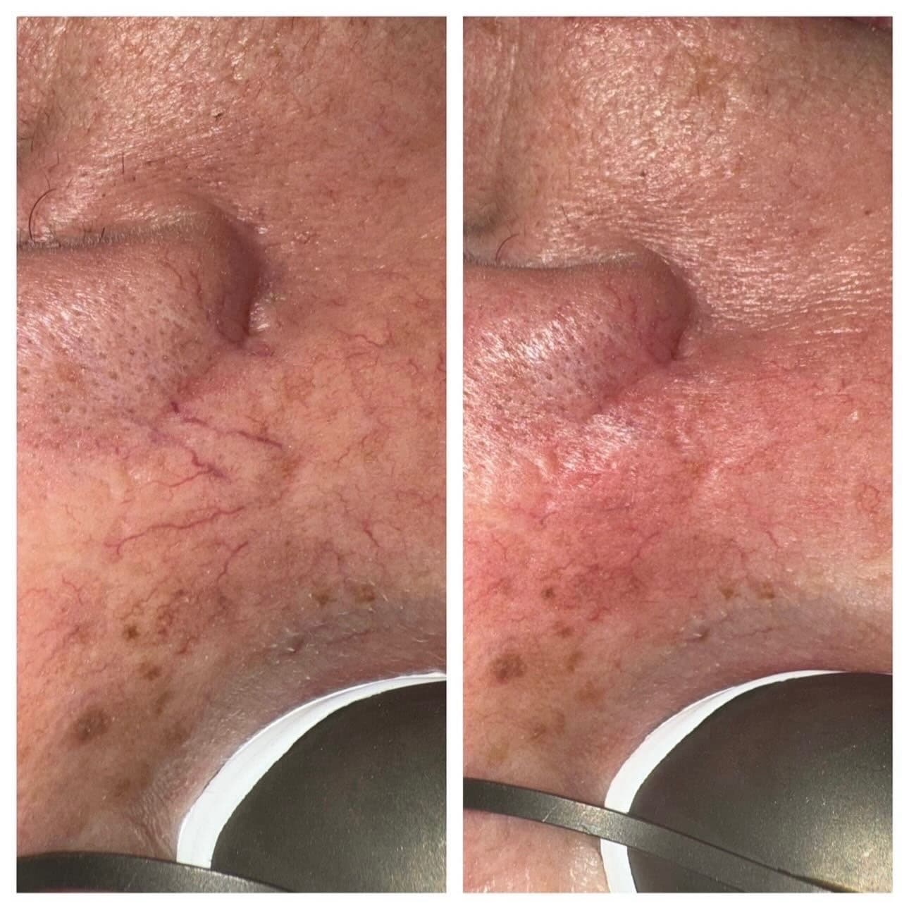 Broken capillaries and redness beside the nose before laser treatment, and reduced after