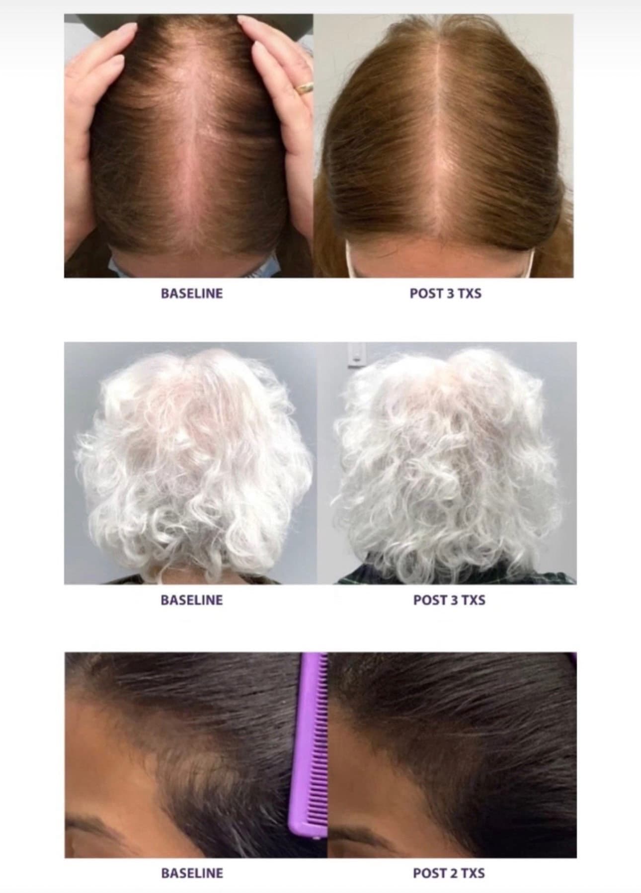 Three patients showing increased density at the part and crown at baseline and after two to three treatments
