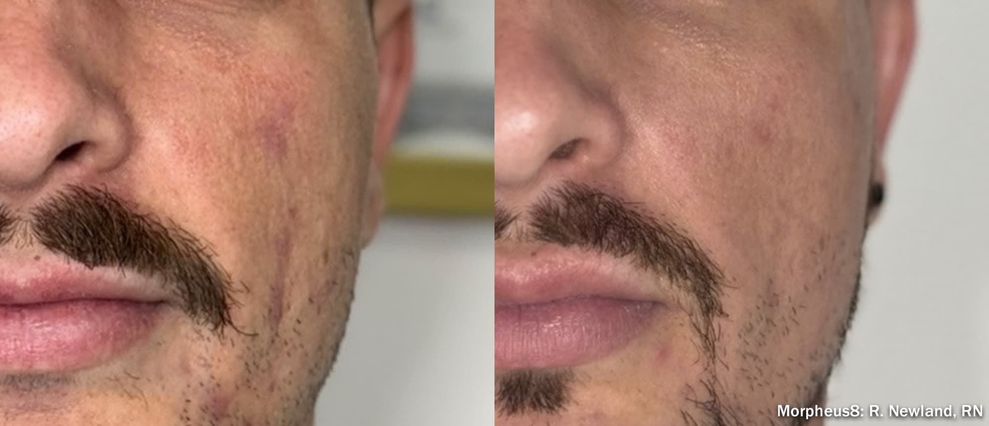Morpheus8 improving skin texture and tone on the cheek, before and after