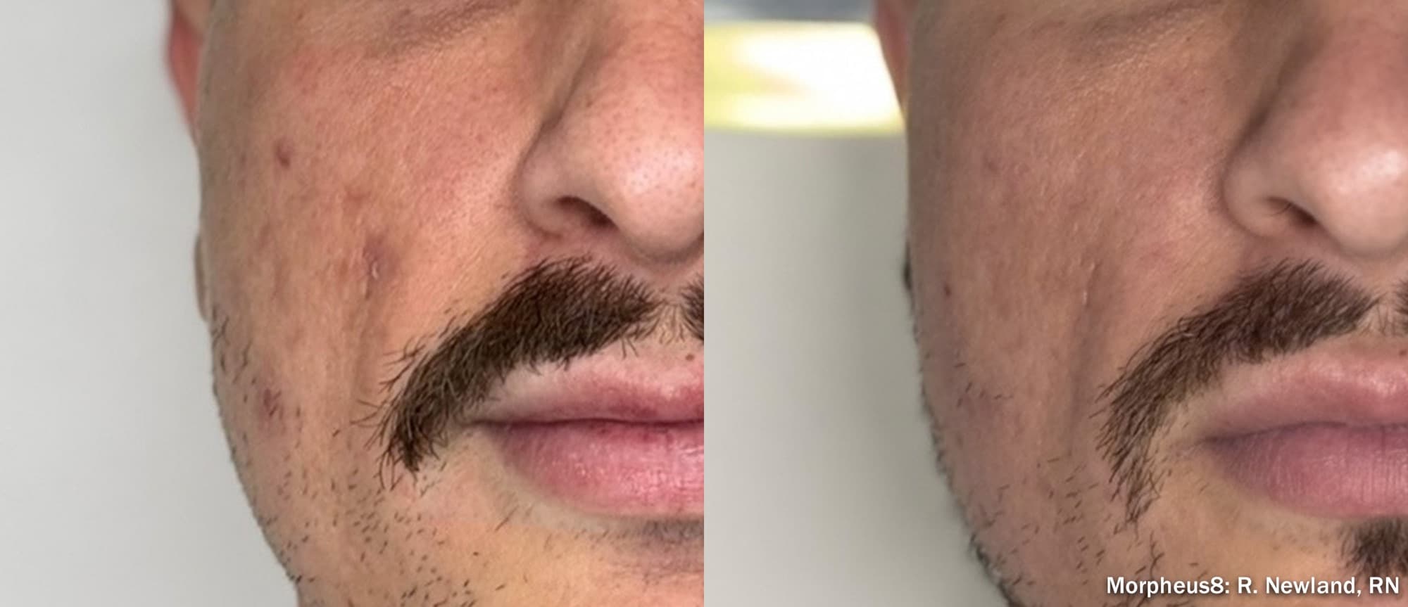 Morpheus8 clearing active acne and refining texture, before and after