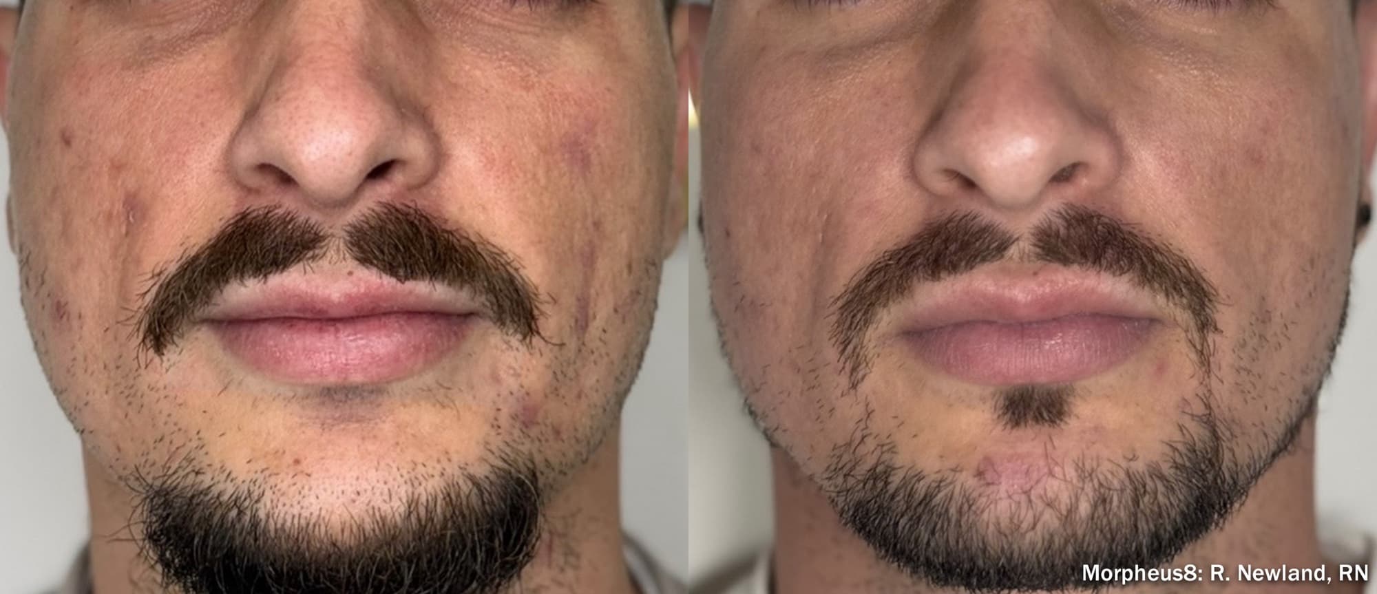 Morpheus8 smoothing skin texture across the face, before and after