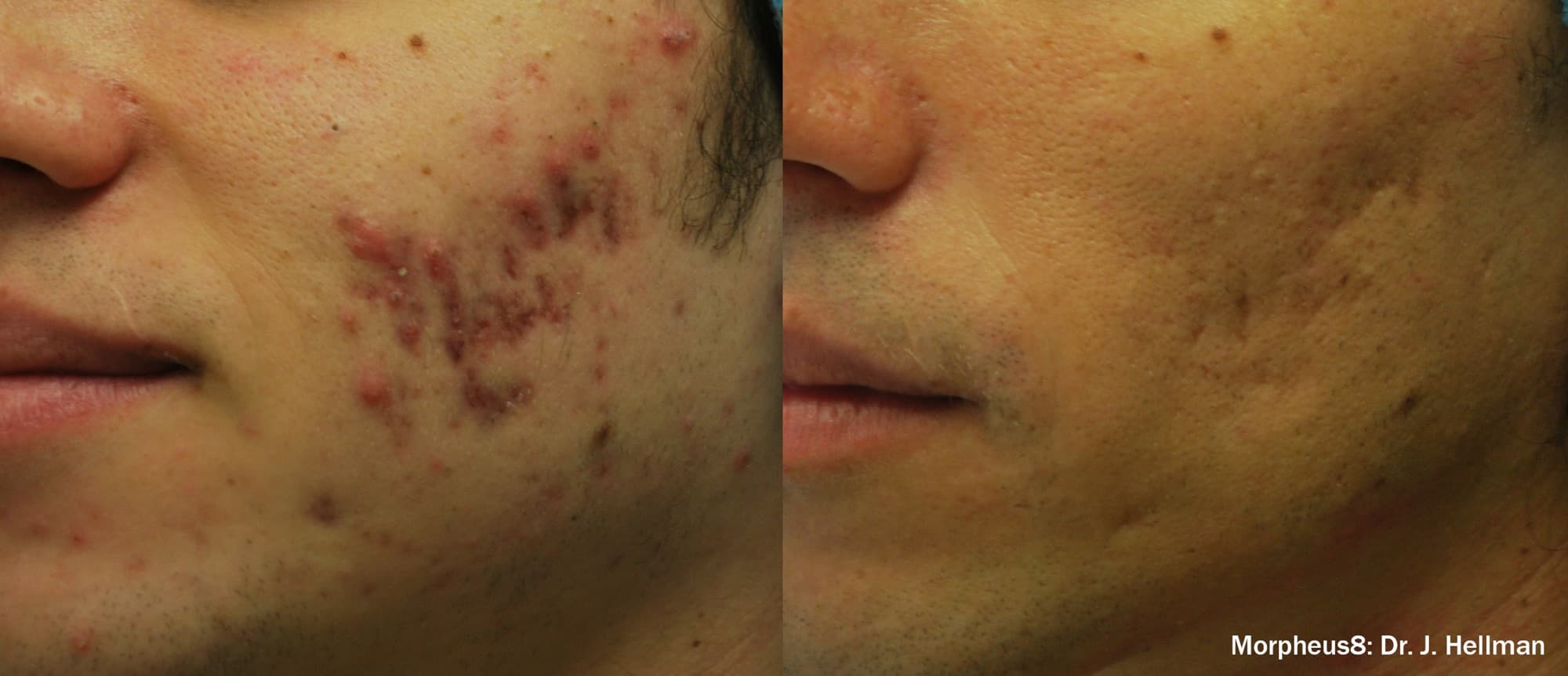 Morpheus8 reducing acne and acne scarring on the cheek, before and after