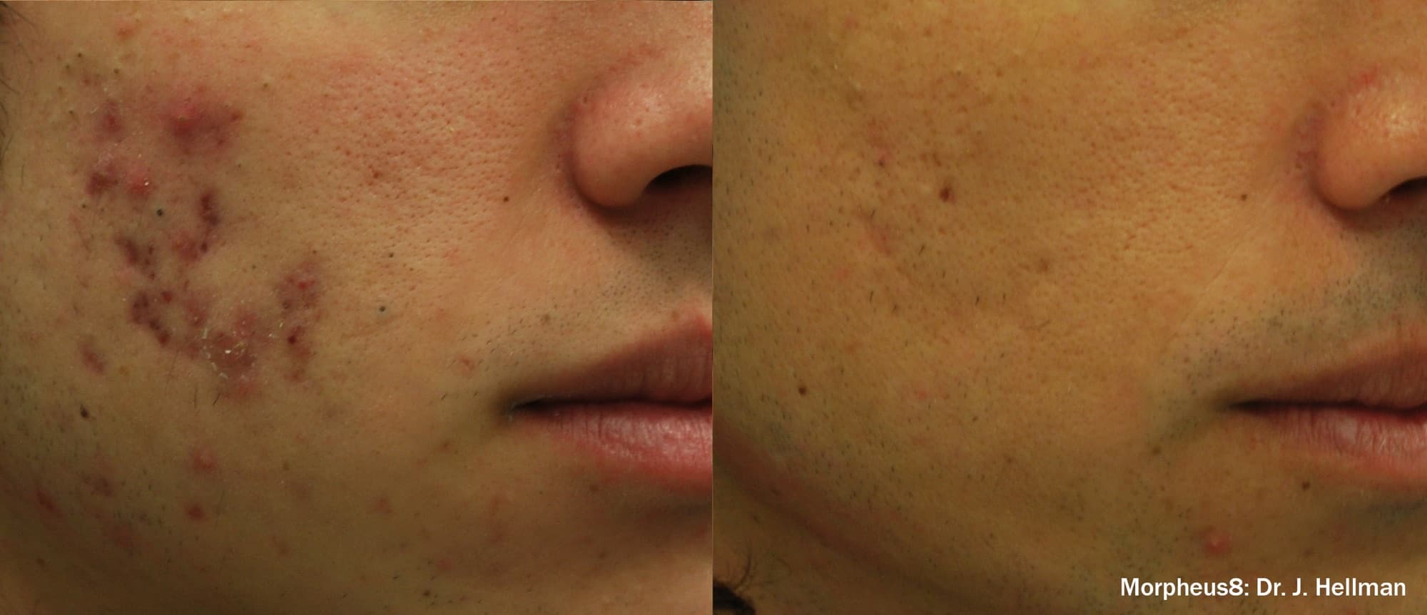Morpheus8 reducing acne and redness on the cheek, before and after