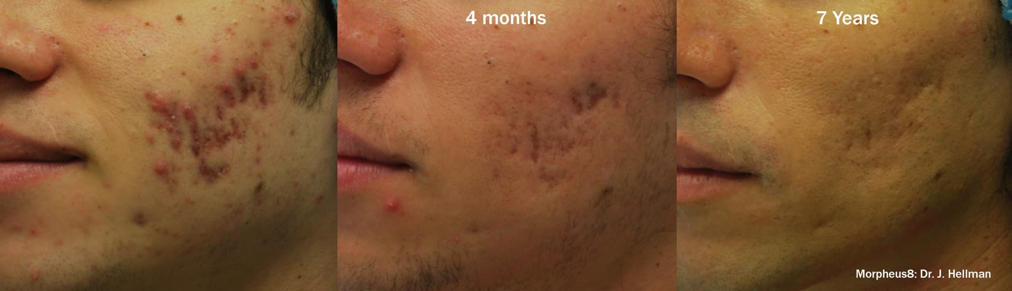 Morpheus8 acne-scar improvement shown before, at 4 months, and at 7 years