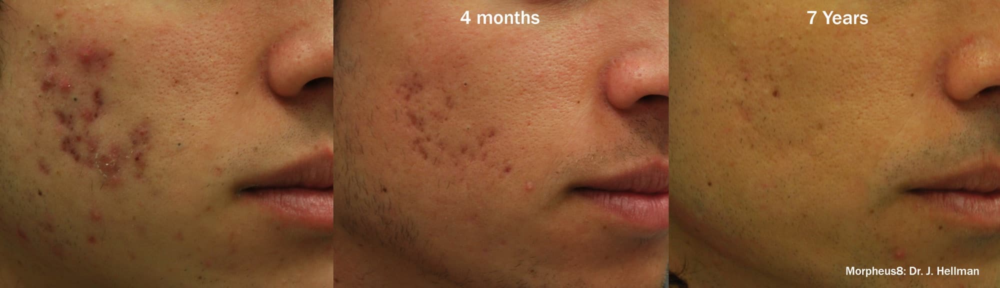 Morpheus8 acne-scar improvement shown before, at 4 months, and at 7 years
