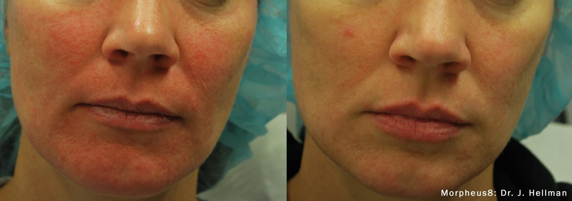 Morpheus8 calming facial redness and rosacea, before and after