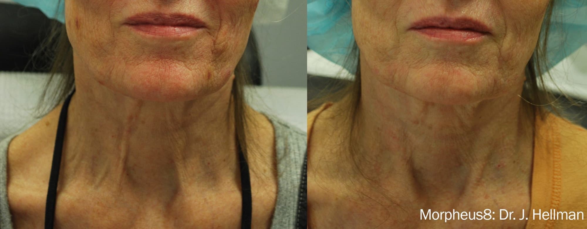 Morpheus8 tightening skin along the jawline and neck, before and after