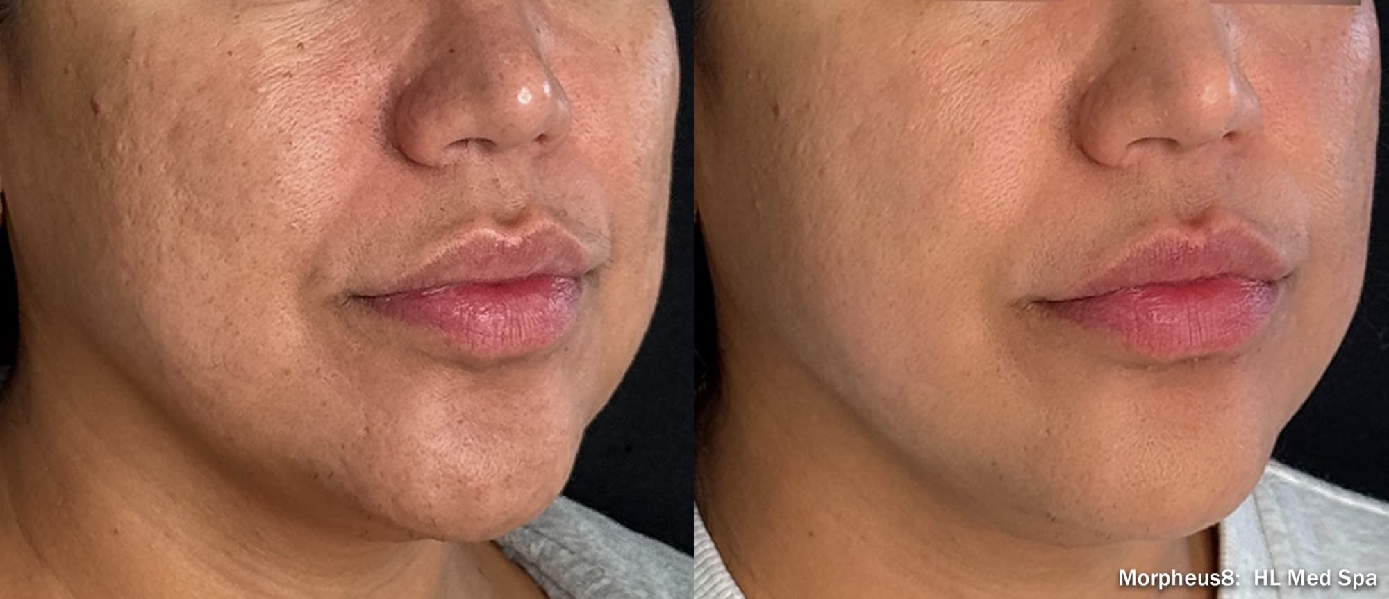 Morpheus8 smoothing texture and pores on the lower face, before and after