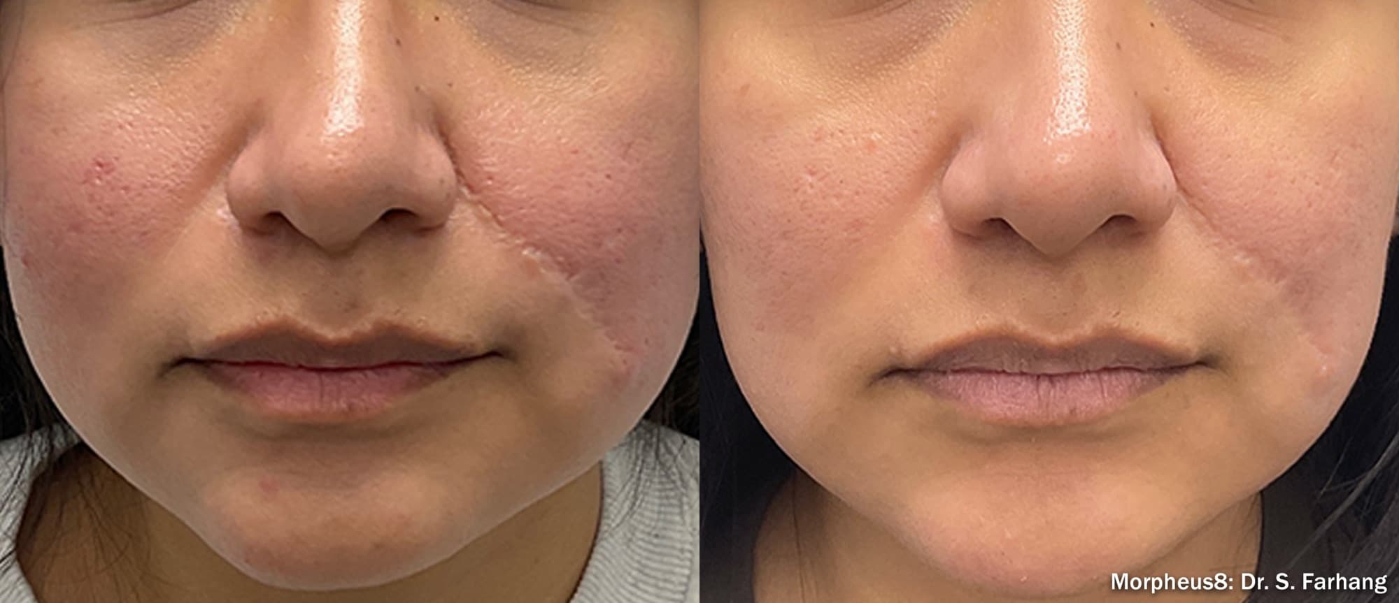 Morpheus8 softening a facial scar, before and after