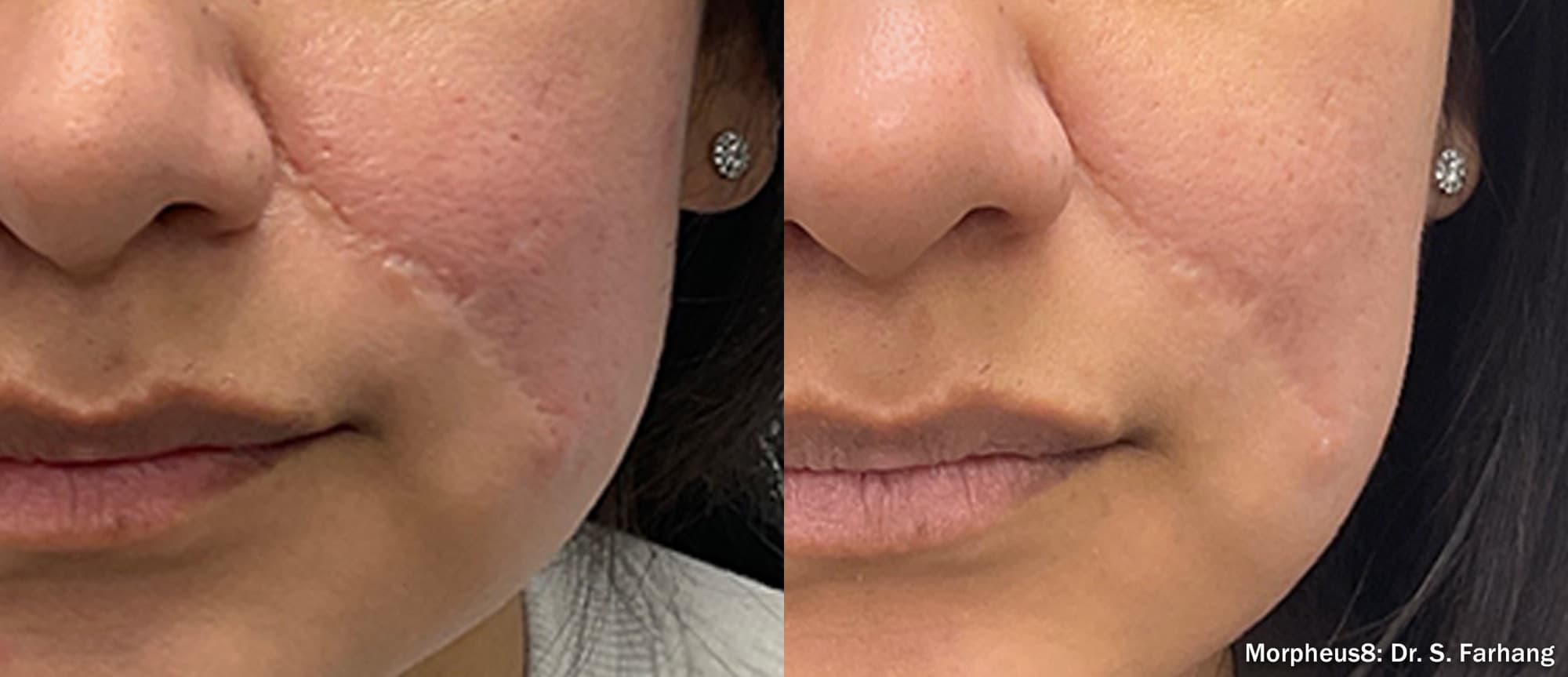 Morpheus8 softening a facial scar and refining texture, before and after