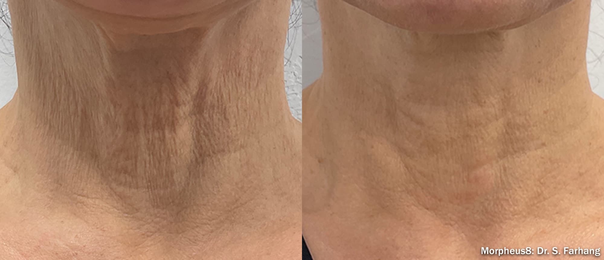 Morpheus8 tightening crepey skin on the neck, before and after