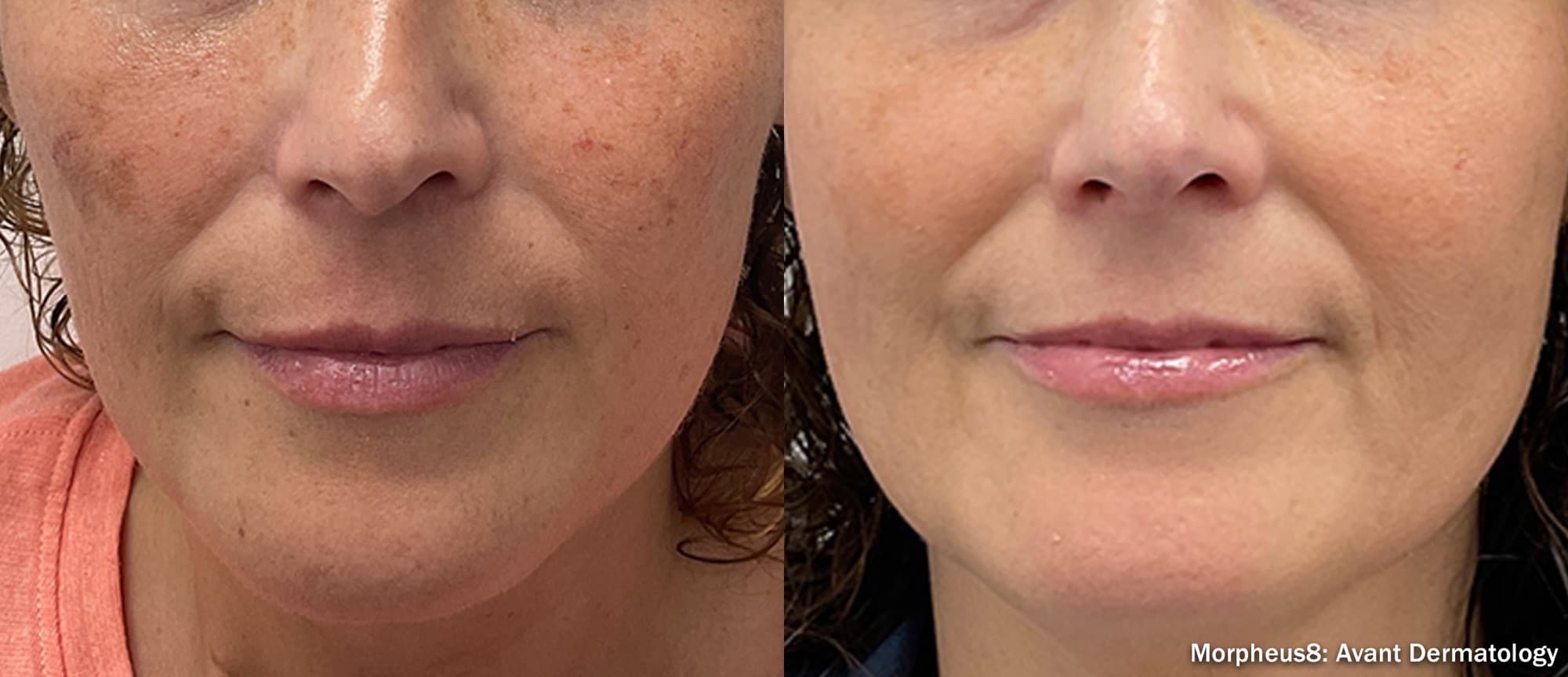 Morpheus8 improving pigmentation and texture on the lower face, before and after