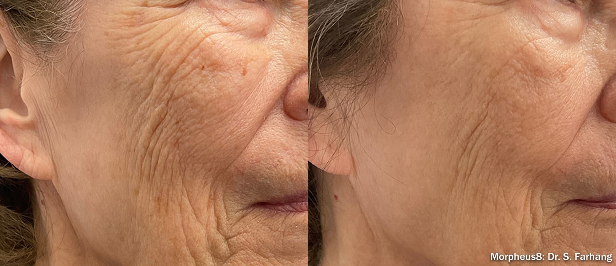 Morpheus8 smoothing fine lines and wrinkles on the cheek, before and after