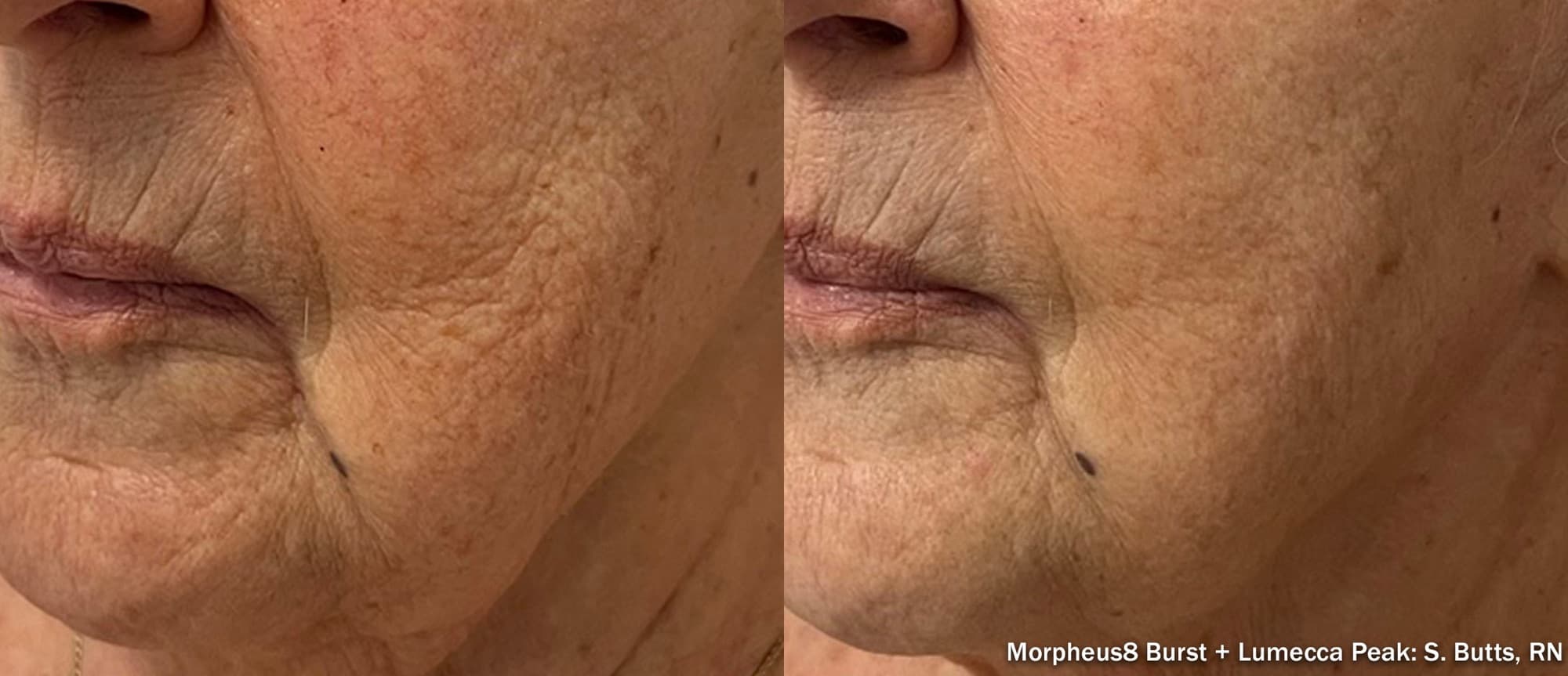 Morpheus8 Burst with Lumecca Peak smoothing deep wrinkles and sun damage, before and after