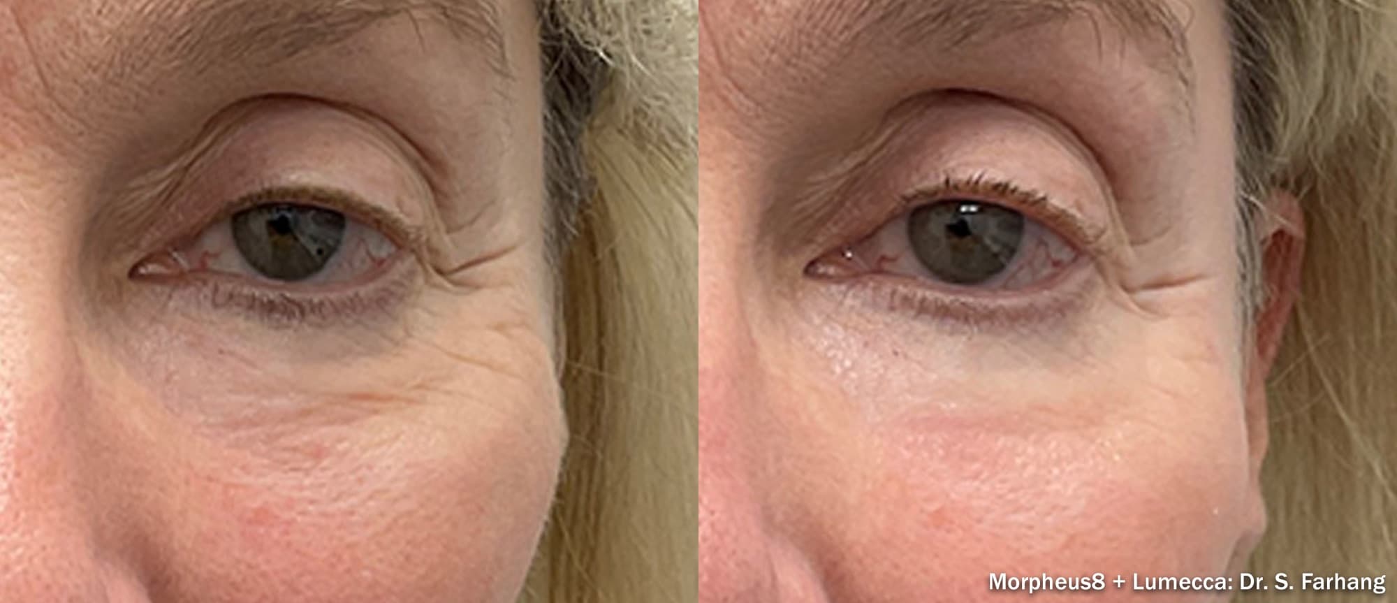 Morpheus8 with Lumecca smoothing under-eye and crow's-feet wrinkles, before and after