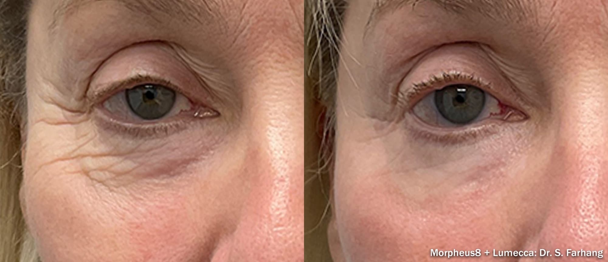 Morpheus8 with Lumecca smoothing wrinkles around the eye, before and after