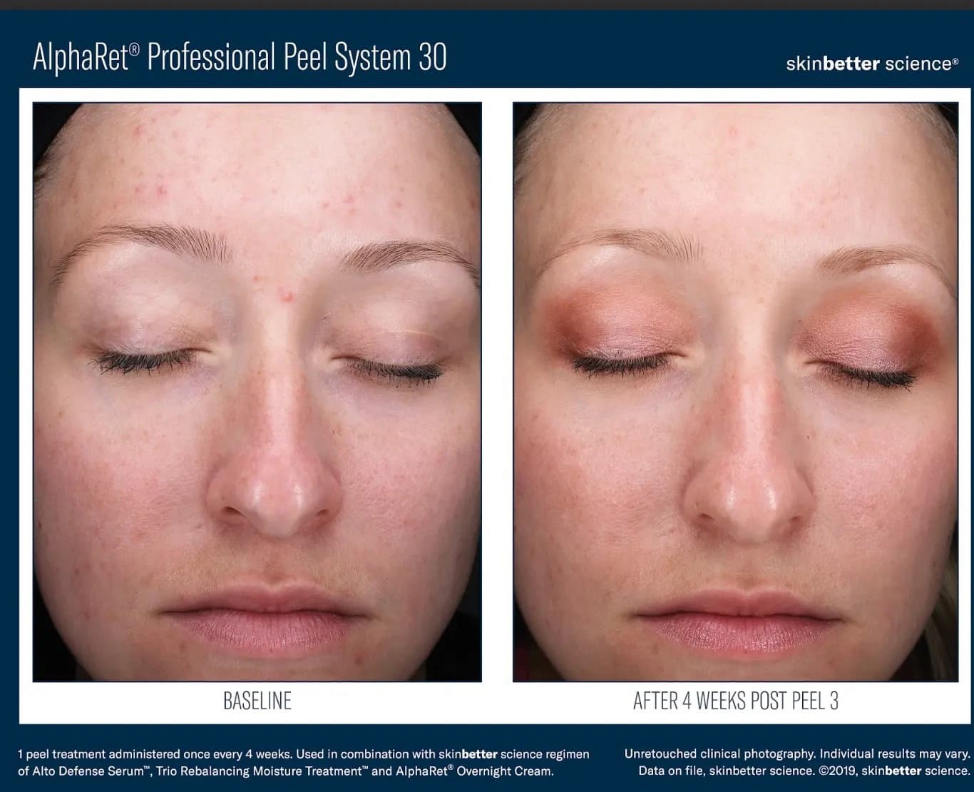 AlphaRet Professional Peel System 30: facial redness and blemishes at baseline, and clearer, more even skin four weeks after a third peel