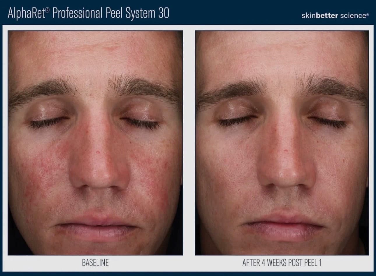AlphaRet Professional Peel System 30: redness and uneven tone across the cheeks at baseline, and calmer, more even skin four weeks after a single peel