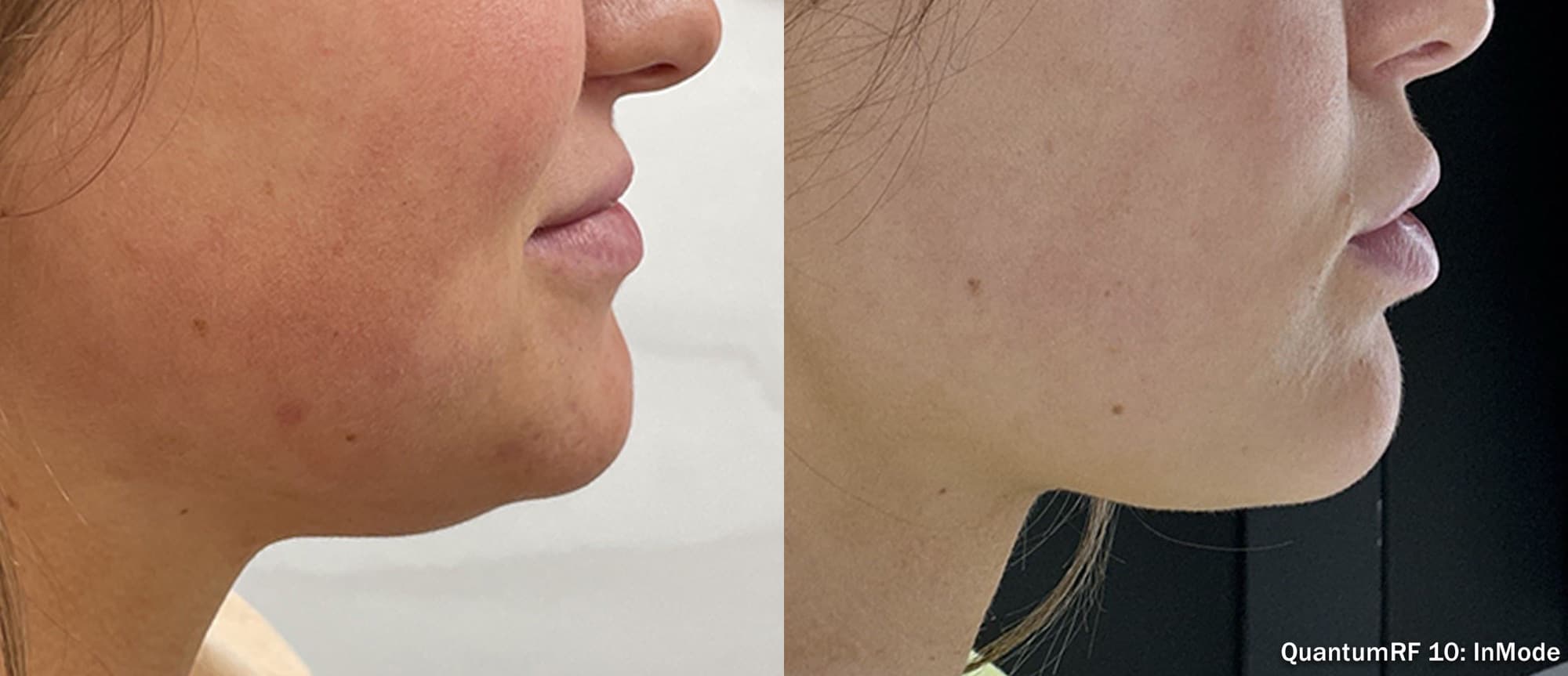 Quantum RF jawline and under-chin contouring, before and after