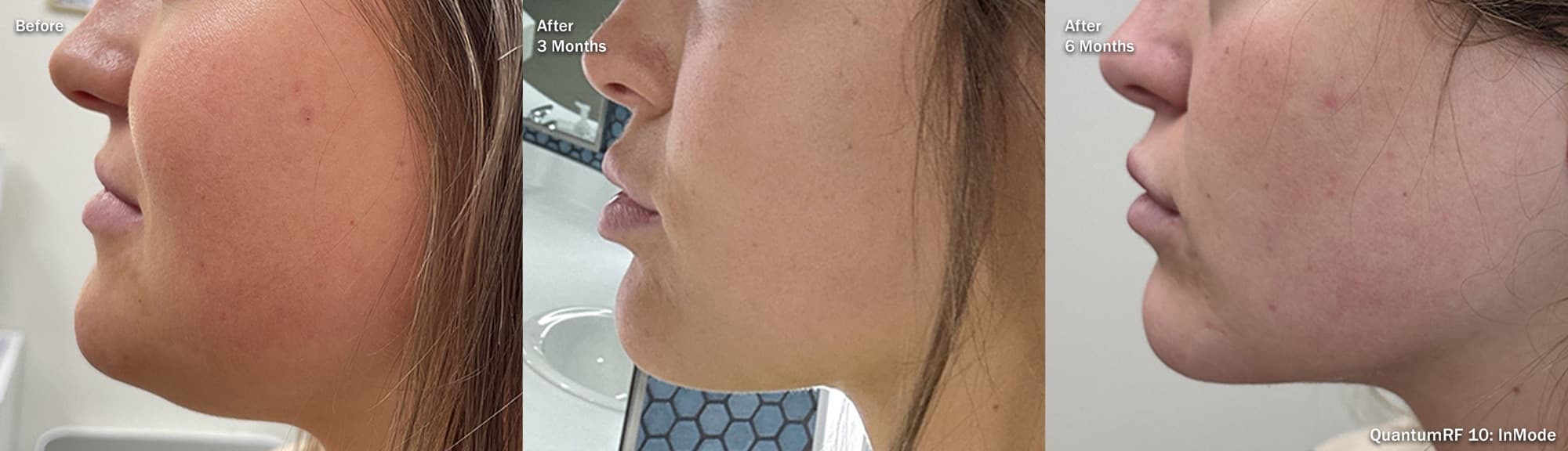 Quantum RF facial contouring shown before, at 3 months, and at 6 months
