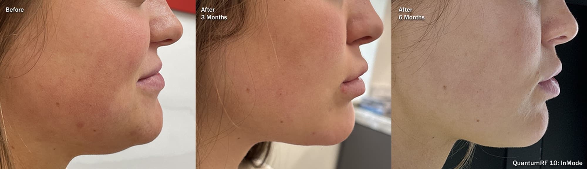 Quantum RF jawline contouring shown before, at 3 months, and at 6 months