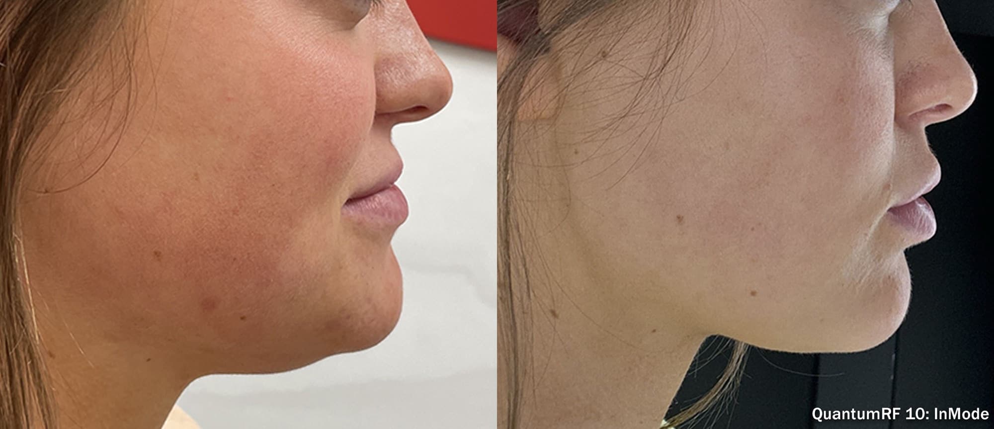 Quantum RF lower face and neck contouring, before and after