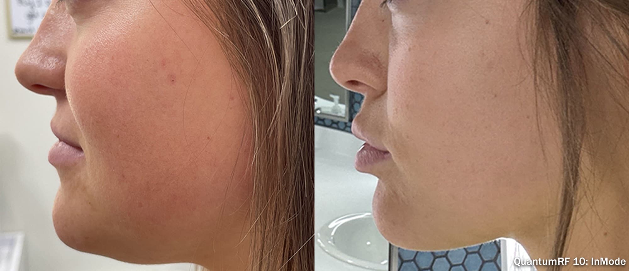 Quantum RF cheek and jawline contouring, before and after