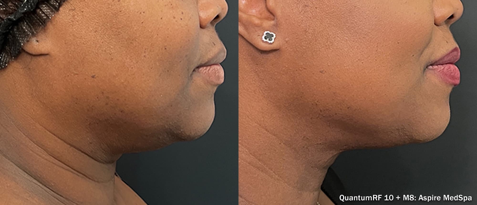 Quantum RF with Morpheus8 neck and jawline contouring, before and after
